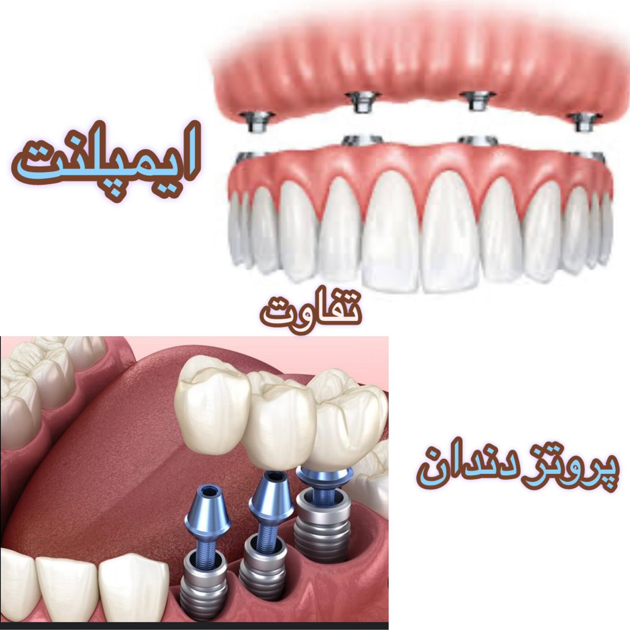 تفاوت ایمپلنت و پروتز دندان