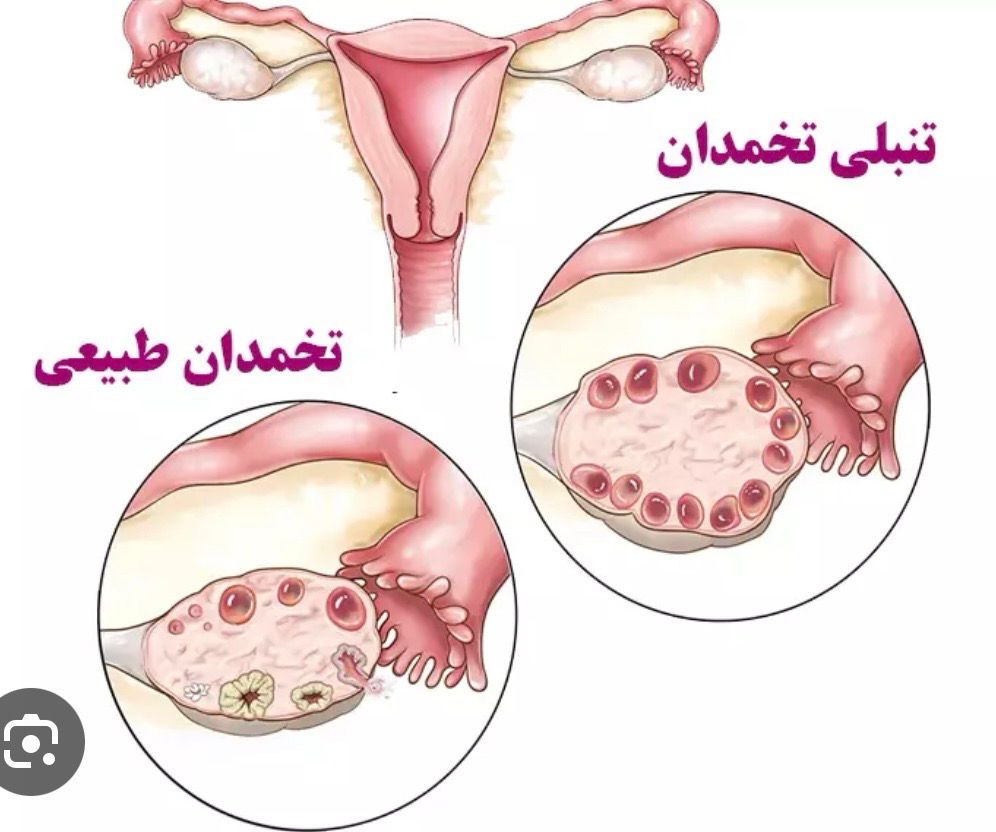 تنبلی تخمدان
